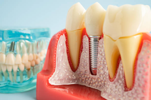 Best Dental Inlays and Onlays  in Durham, OR